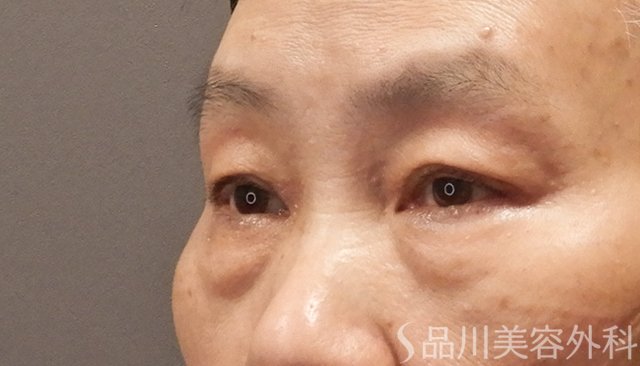 症例NO.74810のBEFORE写真