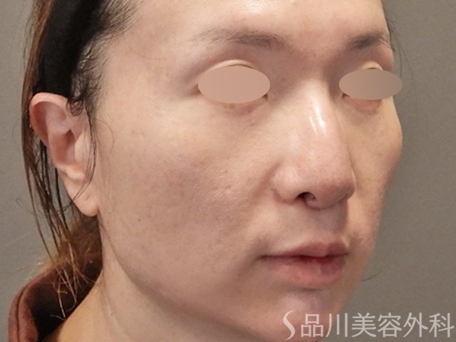 症例NO.74574のAFTER写真