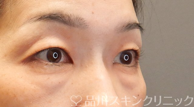 症例NO.75318のBEFORE写真