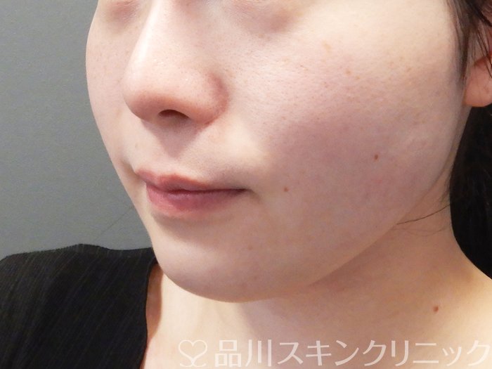 症例NO.72522のBEFORE写真