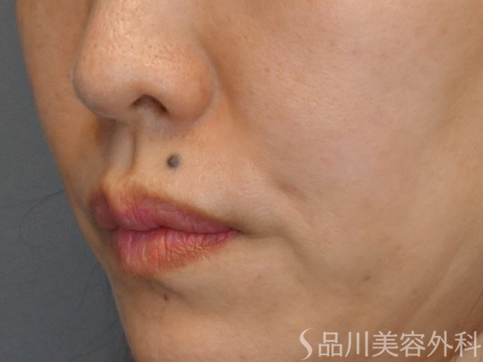 症例NO.72494のBEFORE写真