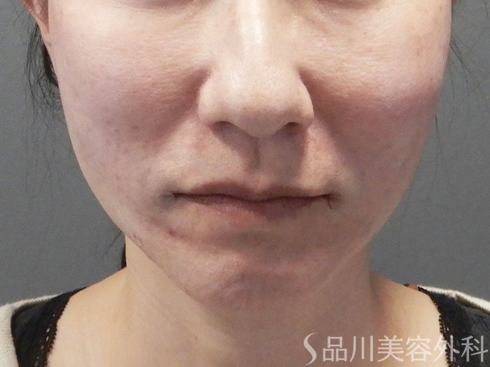 症例NO.72103のAFTER写真