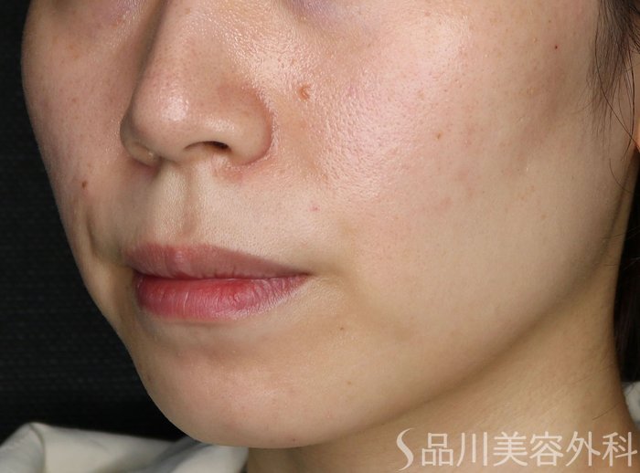 症例NO.71110のAFTER写真