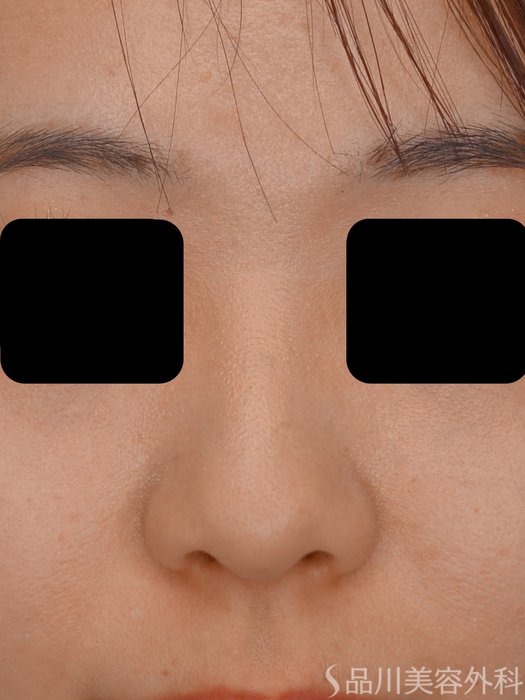 症例NO.73467のBEFORE写真