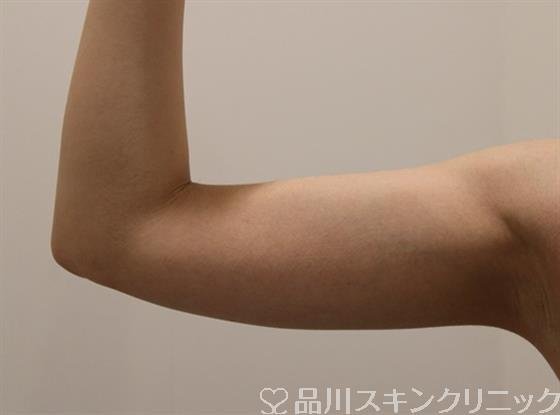 症例NO.47161のAFTER写真