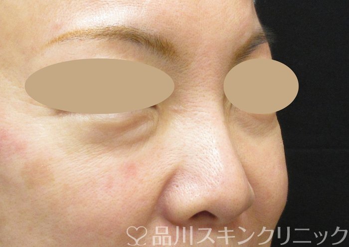 症例NO.73966のBEFORE写真