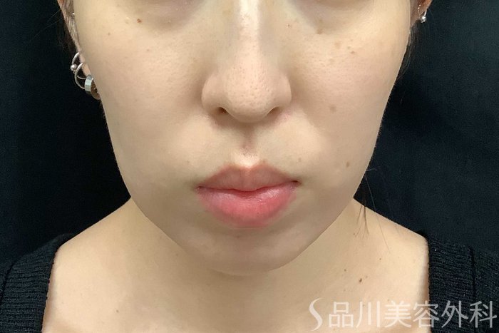 症例NO.69775のBEFORE写真