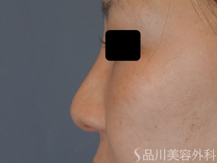 症例NO.72949のBEFORE写真