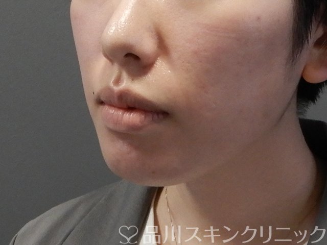 症例NO.64460のBEFORE写真
