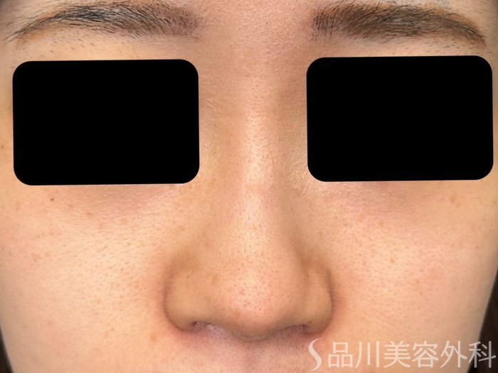 症例NO.74882のBEFORE写真