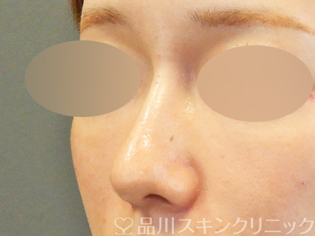 症例NO.67901のAFTER写真