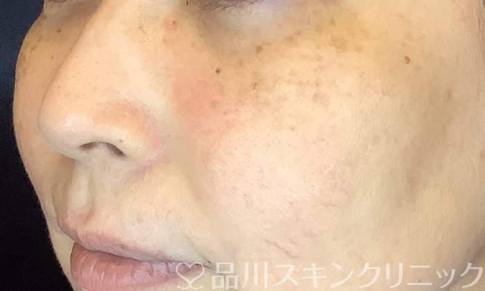 症例NO.71195のBEFORE写真
