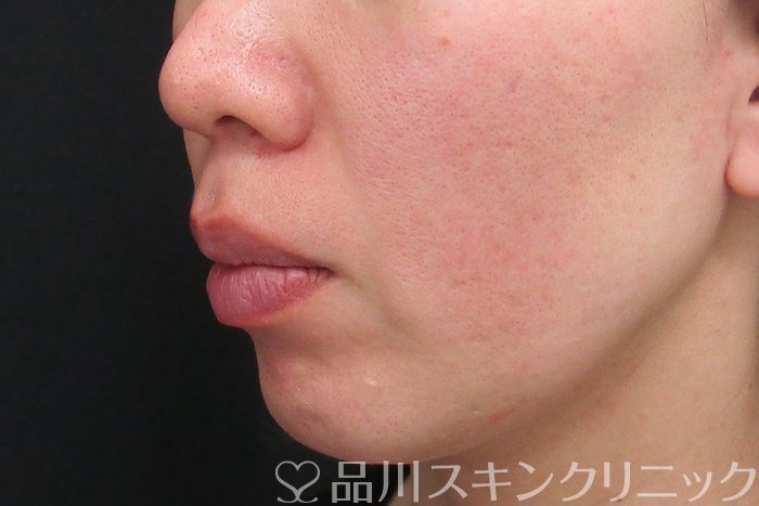 症例NO.73879のBEFORE写真