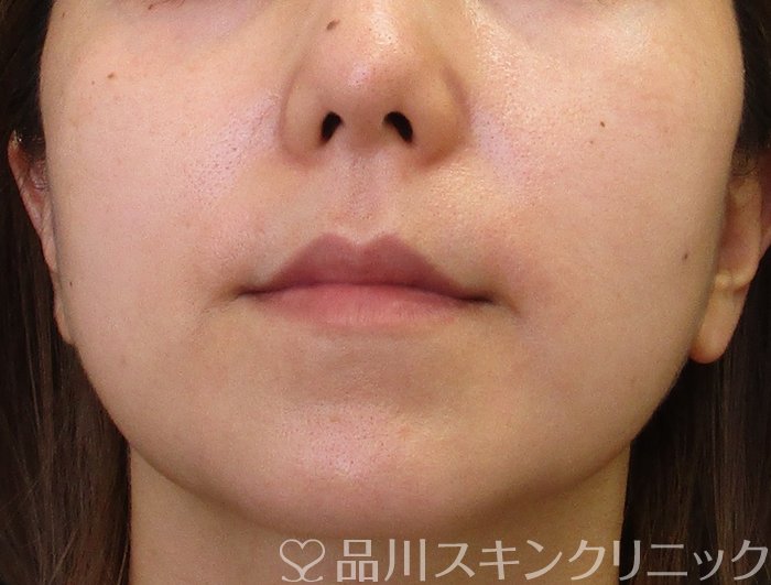 症例NO.65464のBEFORE写真