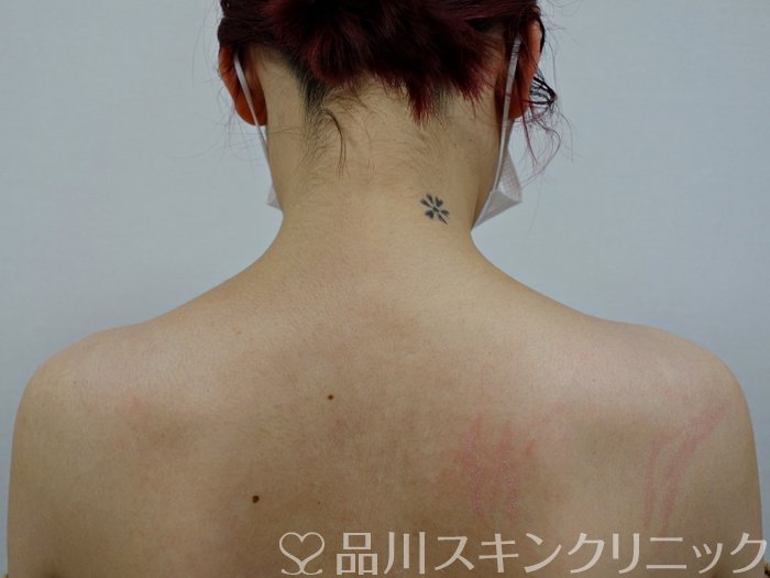 症例NO.73394のBEFORE写真