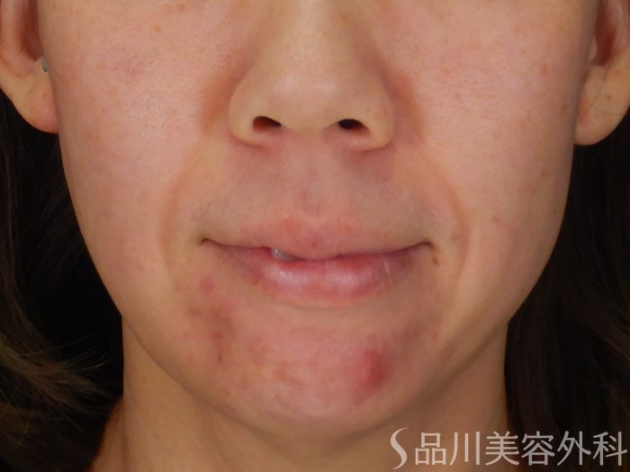 症例NO.69873のBEFORE写真