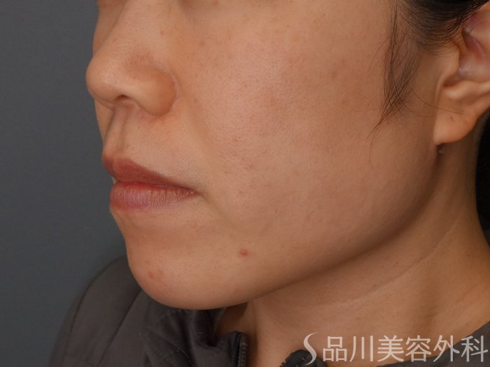 症例NO.73613のAFTER写真