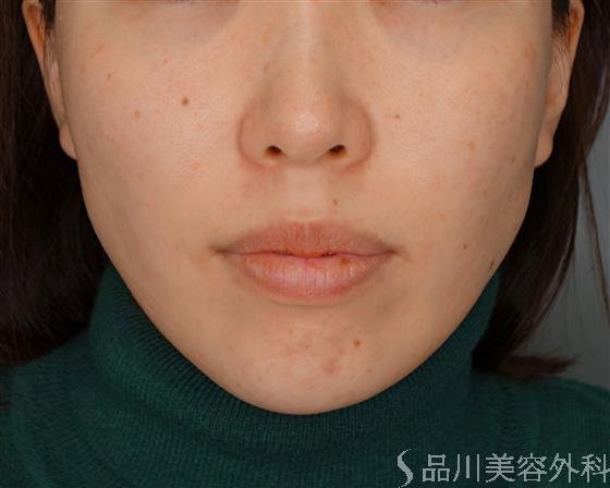 症例NO.53612のBEFORE写真