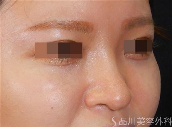 症例NO.61897のBEFORE写真