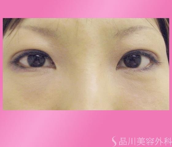 症例NO.1370のAFTER写真