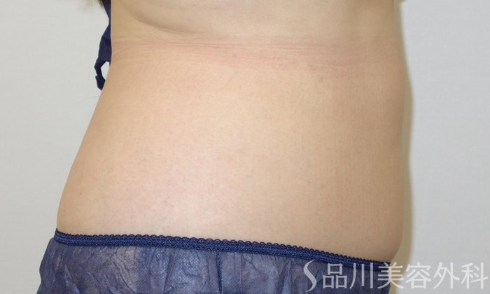 症例NO.72993のBEFORE写真