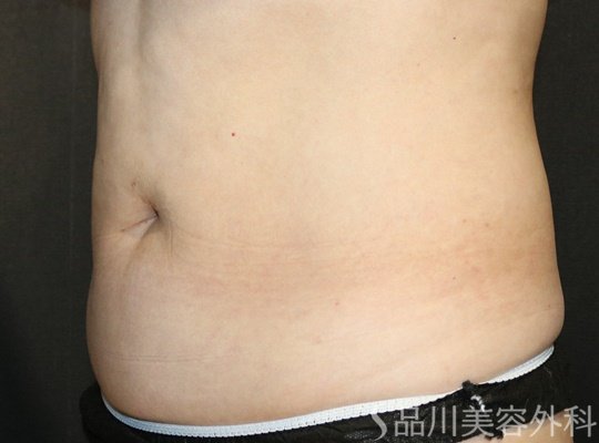 症例NO.73692のAFTER写真