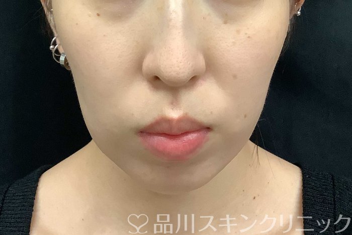 症例NO.69775のBEFORE写真