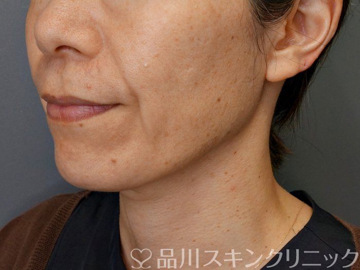 症例NO.71381のBEFORE写真