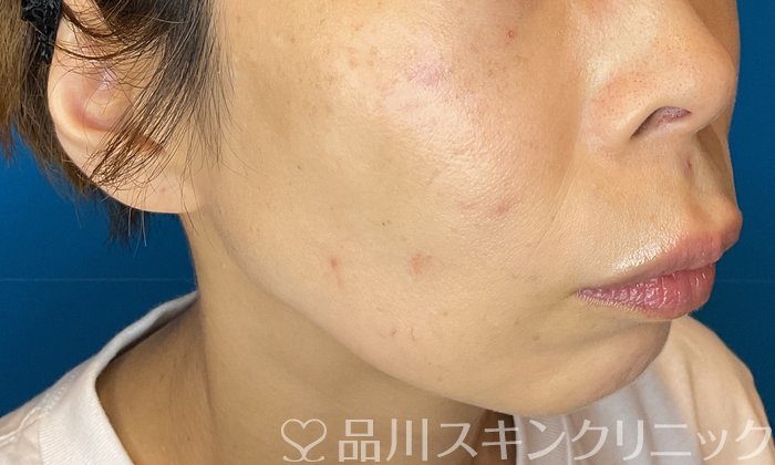 症例NO.74511のAFTER写真