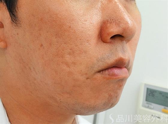 症例NO.30849のAFTER写真