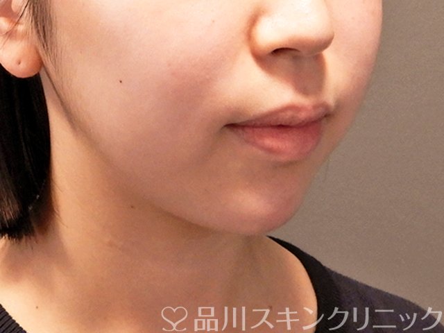 症例NO.70992のAFTER写真