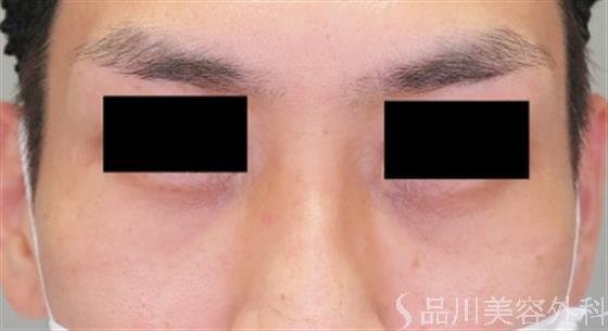 症例NO.47779のAFTER写真