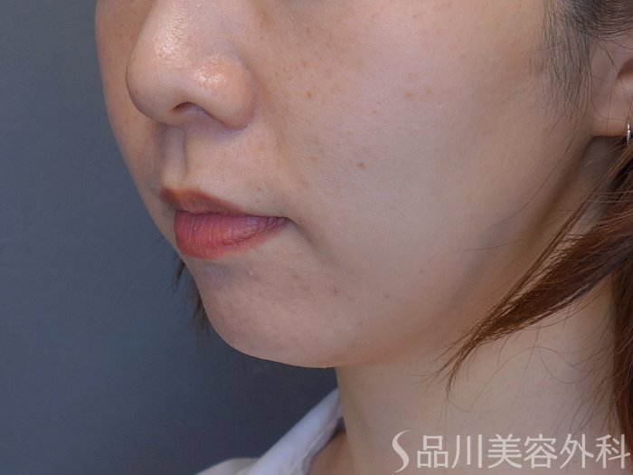 症例NO.74004のBEFORE写真