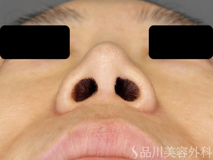症例NO.71422のBEFORE写真