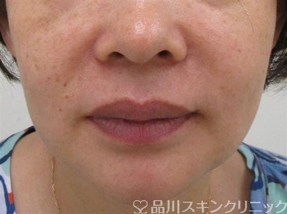 症例NO.37445のBEFORE写真