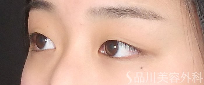 症例NO.65545のBEFORE写真