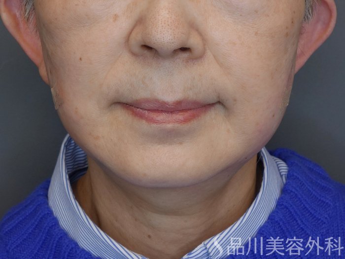 症例NO.72779のAFTER写真