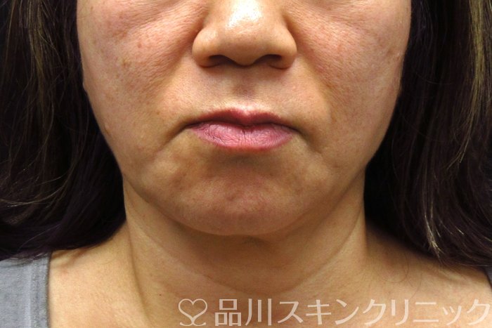 症例NO.74589のBEFORE写真