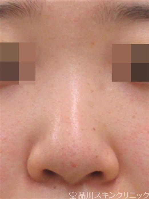 症例NO.29161のBEFORE写真