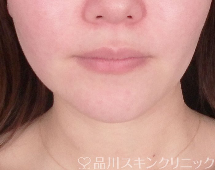 症例NO.69771のBEFORE写真