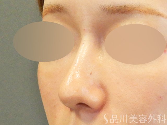 症例NO.67901のAFTER写真