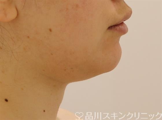 症例NO.43986のBEFORE写真