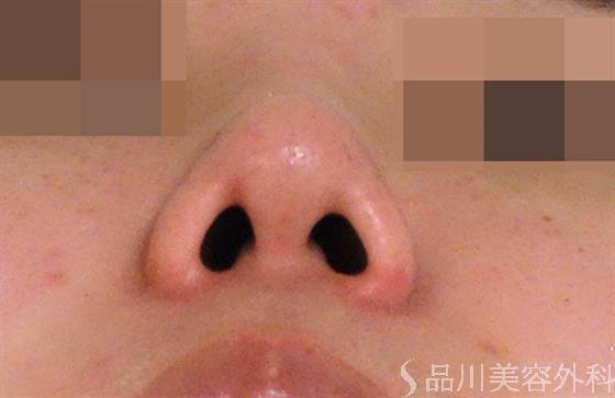 症例NO.39253のAFTER写真