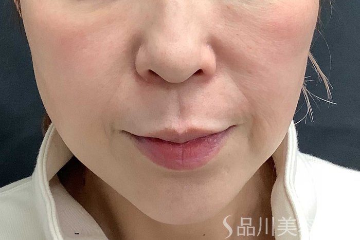 症例NO.62965のBEFORE写真