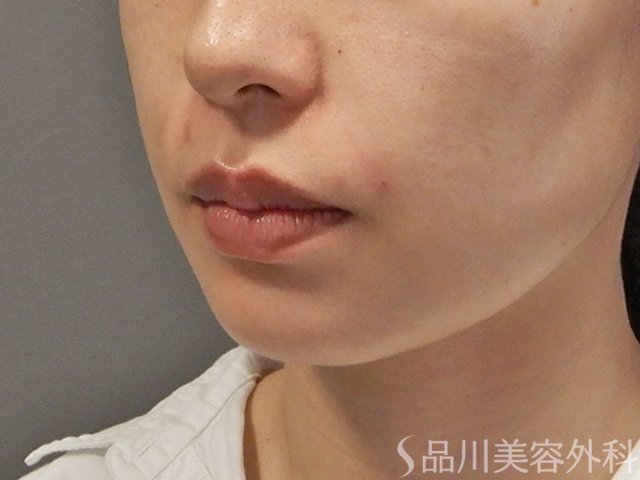 症例NO.74654のAFTER写真