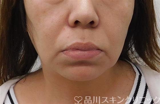 症例NO.42399のBEFORE写真