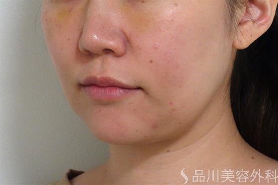 症例NO.36194のBEFORE写真