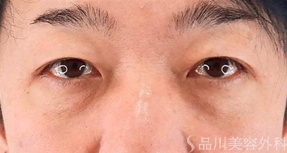 症例NO.60633のBEFORE写真