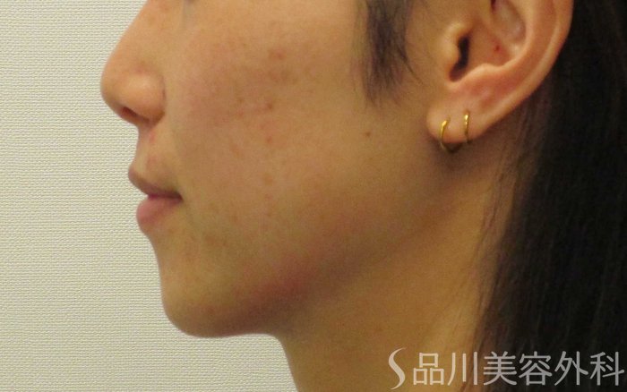 症例NO.70607のBEFORE写真