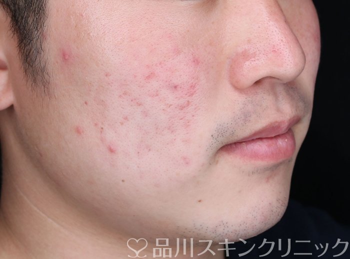 症例NO.70401のBEFORE写真